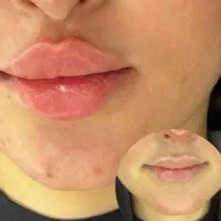 ژل و بوتاکس چال گونه مزو