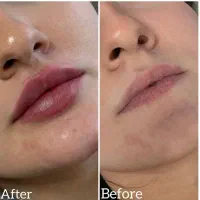 جشنواره کلینیک زیبایی / بوتاکس فیلر مزو ژل لب روسی|خدمات آرایشگری و زیبایی|مشهد, هنرستان|دیوار