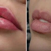 تزریق فیلر و بوتاکس با تخفیف به مدت محدود