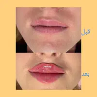 جشنواره تزریق ژل و بوتاکس وانزیم|خدمات آرایشگری و زیبایی|ملارد, |دیوار