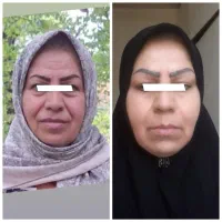 خدمات زیبایی نصف قیمت(جوانسازی.فیشیال