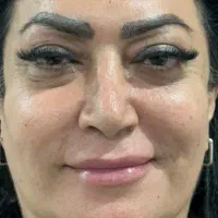 جشنواره اندولیفت تخصصی صورت وگردن