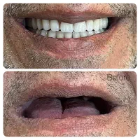 دندان مصنوعی