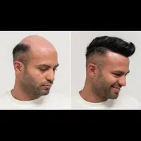 پروتز دائمی مو ویژه  نوروز ۱۴۰۵