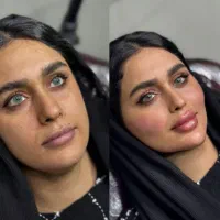 ژل و فیلر صورت و بدن و بوتاکس و فیلر بادی