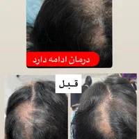 پاکسازی سر،موخوره گیری،اسکالپ،درمان ریزش،رویش مجدد|خدمات آرایشگری و زیبایی|قم, هفت تیر|دیوار