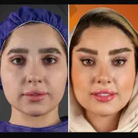 جشنواره ویژه لیفت شقیقه و بلفارو