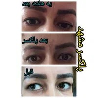 جوان سازی و لیفت به روش پلکسر بدون عمل جراحی|خدمات آرایشگری و زیبایی|مشهد, طلاب|دیوار