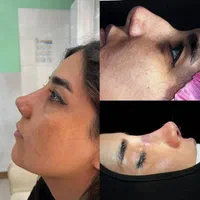 عمل بینی با تخفیف جشنواره تابستانه ویژه فقط ۲۵تومن|خدمات آرایشگری و زیبایی|تهران, عباس‌آباد|دیوار