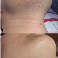 بوتاکس پیشانی و خط اخم رایگان شد توسط پزشک|خدمات آرایشگری و زیبایی|کاشان, بهشتی|دیوار