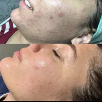 هایفوتراپی و فشیال پوست کره ای|خدمات آرایشگری و زیبایی|یزد, |دیوار