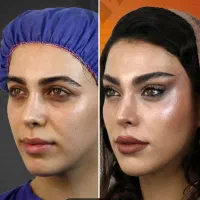 آف۵۰٪پکیج ابرو FOX EYE پزشک پلک غبغب ژل بینی شقیقه|خدمات زیبایی و سلامت|مشهد, هنرستان|دیوار