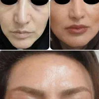 مطب پوست موزیبایی لیزرحذف تتوبالیزرQsبا۱۷سال تجربه|خدمات آرایشگری و زیبایی|تبریز, |دیوار