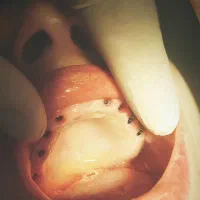 ایمپلنت فقط ۸۵۰۰