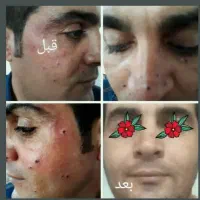پوست زیبایی|خدمات آرایشگری و زیبایی|رباط‌کریم, الارد|دیوار