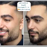 تزریق ژل لب بوتاکس کانتورینگ صورت جوانسازی لیفت|خدمات آرایشگری و زیبایی|تهران, صادقیه|دیوار