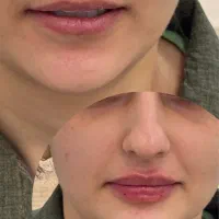 جشنواره تخفیفی فیلر بوتاکس و مزوژل