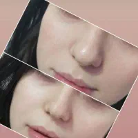 ژل بوتاکس پی آرپی لیفت توسط پزشک در مطب