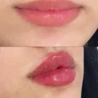 آف ویژه لاین زیبایی و لیزر تا آخر ماه