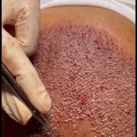 کاشت مو و ابرو در کلینیک تخصصی پوست و مو