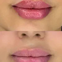 تزریق ژل وبوتاکس تخفیف ویژه|خدمات آرایشگری و زیبایی|تهران, خانی آباد نو شمالی|دیوار
