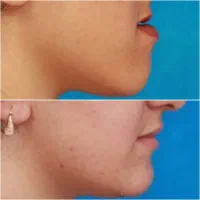 اورتودنسی دندان/۱۰م تخفیف/اقساط بدون سود|خدمات آرایشگری و زیبایی|فسا, |دیوار