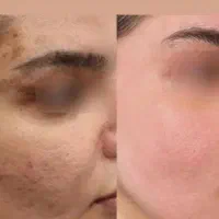 کرم سفید کننده صورت و دست و پا