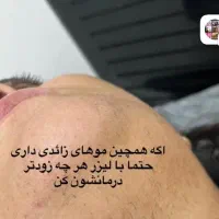 لیزر موهای زائد بدن