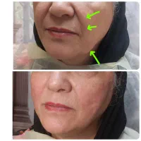 لیفت صورت با نخ جوانسازی پوست تزریق ژل بوتاکس|خدمات زیبایی و سلامت|تهران, جردن|دیوار