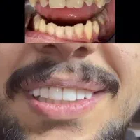 جشنواره دندانپزشکی (تمامی خدمات)|خدمات آرایشگری و زیبایی|اصفهان, لنبان|دیوار