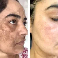 به مدل جهت انجام تکنیک آیینه سازی پوست