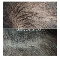 با تکنیک میکرواسکالپ،کم پشتی مو دیگه دیده نمیشه