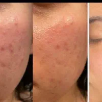 فیشیال تخصصی صورت با زیر قیمت