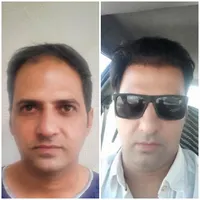 کاشت مو تیم از شیراز.قیمت از ۱۷ تومن به بالا