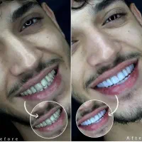 دندانپزشکی/کامپوزیت/عصبکشی دندان/ترمیم/ایمپلنت|خدمات زیبایی و سلامت|تهران, تهرانپارس شرقی|دیوار