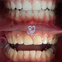 سفید کردن دندان (بلیچینگ)|خدمات آرایشگری و زیبایی|فولادشهر, B2|دیوار