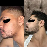 راهکار تخصصی برای پرپشت شدن ریش