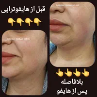 ** جوانسازی پوست با هایفو تنها ۹۸۰ هزار **|خدمات آرایشگری و زیبایی|تهران, نازی‌آباد|دیوار