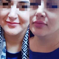 تزریق ژل لب.گونه.چانه.زاویه سازی فک.آنزیم بینی|خدمات آرایشگری و زیبایی|اردکان, |دیوار