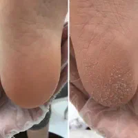 پدیکور پا در سهند با دستگاه تخصصی