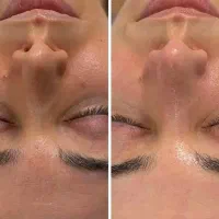 آموزش و ورکشاپ پوستی فیشیال
