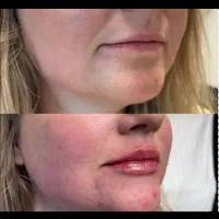 تخفیفات ژل بوتاکس مزو میکرو پی آرپی