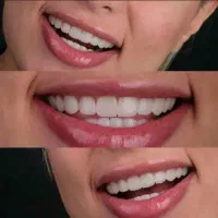 لمینت متحرک دندان