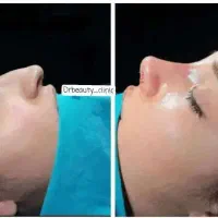 جراحی بینی29اقساطی/بابهترین جراحان زیبایی