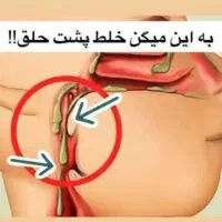 خلط پشت حلق