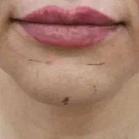 تزریق فیلر و بوتاکس