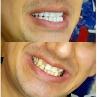 کامپوزیت دندان|خدمات آرایشگری و زیبایی|اندیشه, شهرک صدف|دیوار