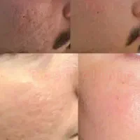 مرکزتخصصی نیدلینگ/مزوتراپی منطقه نواب|خدمات زیبایی و سلامت|تهران, سلسبیل جنوبی|دیوار