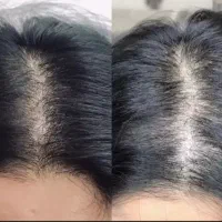 رفع ریزش مو