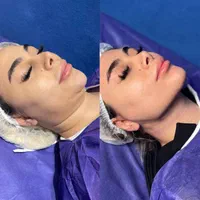 جشنوار بلفاروپلاستی-غبغب-بوکال فت-سانترال لب|خدمات آرایشگری و زیبایی|تهران, پاسداران|دیوار